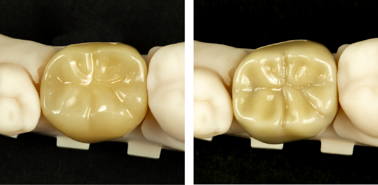 Droid-dental-crown-comparison2.0