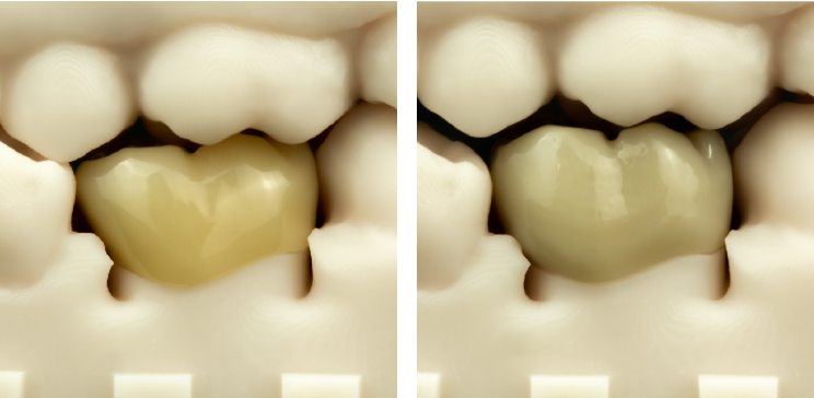Droid-dental-crown-comparison2.1