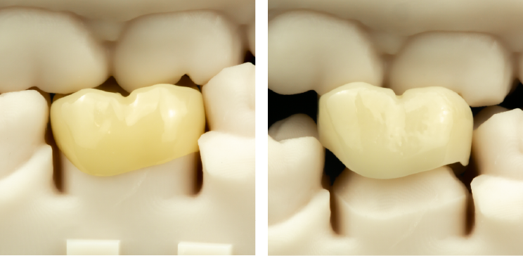 Droid-dental-crown-comparison3.0