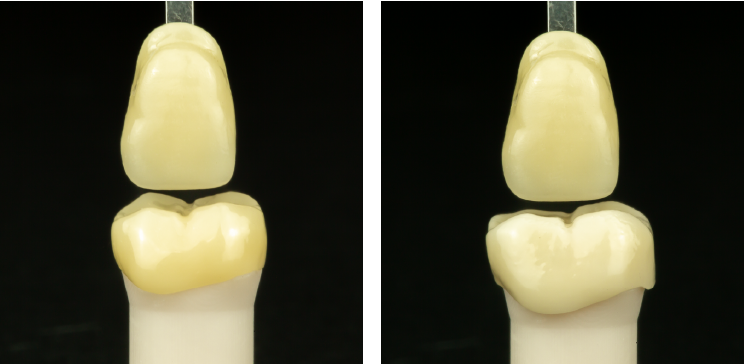 Droid-dental-crown-comparison3.2
